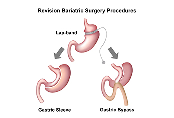 Gastric Revision Surgery