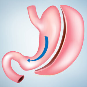 Who Performs Weight Loss Surgery? A Comprehensive Guide to Gastric Sleeve Surgeons