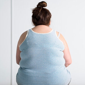 Продольная резекция желудка